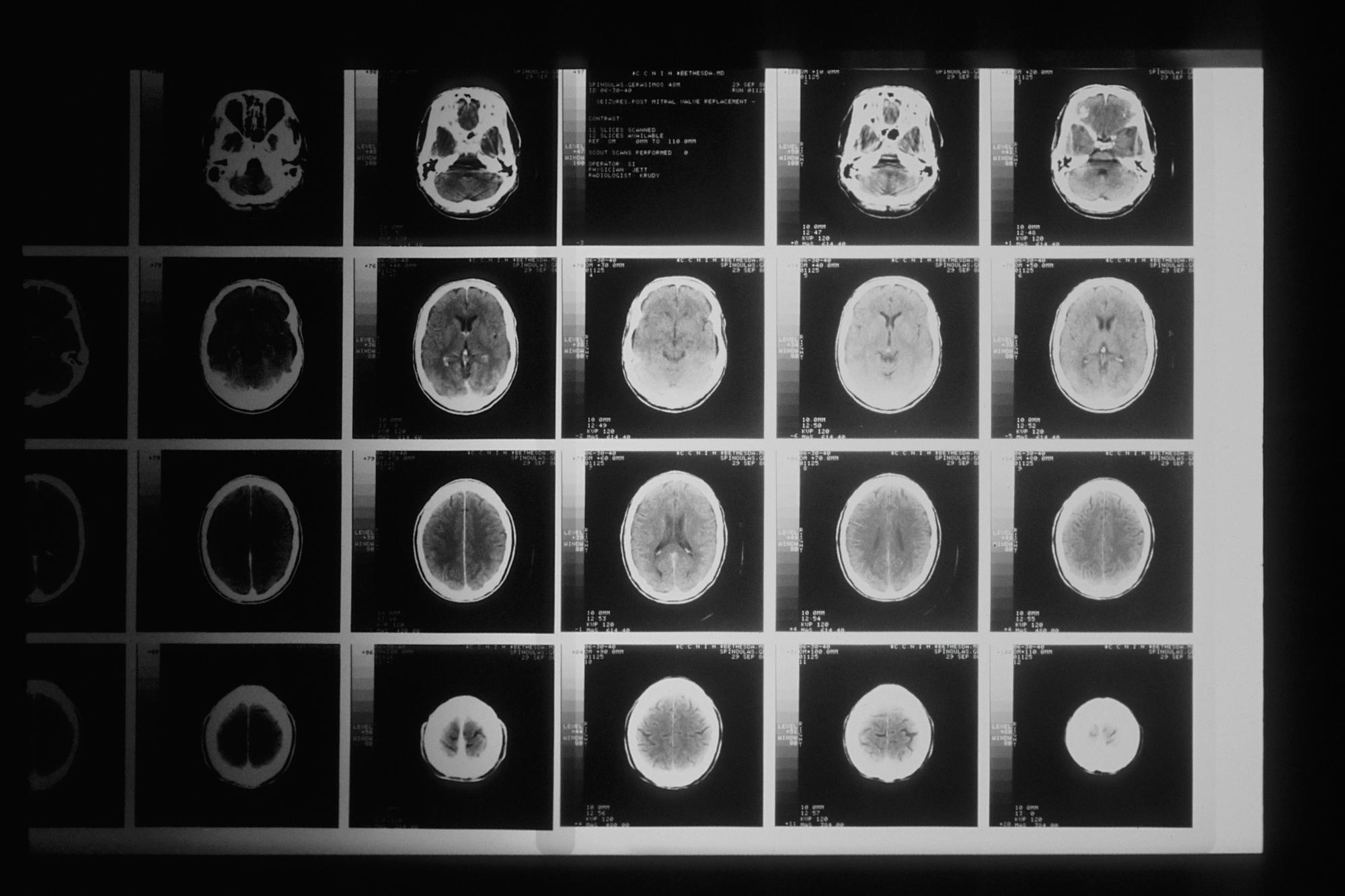 Brain scan